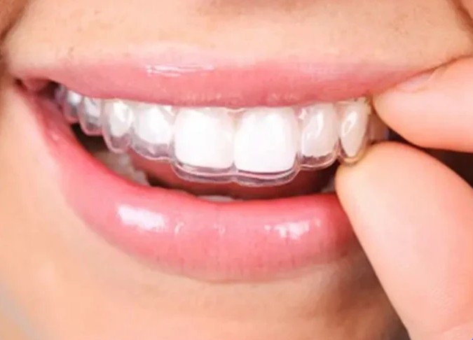 Sorriso com alinhador invisível