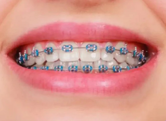Sorriso com aparelho fixo de brackets